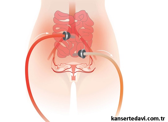 hipek sıcak kemoterapi hangi hastalara uygulanır