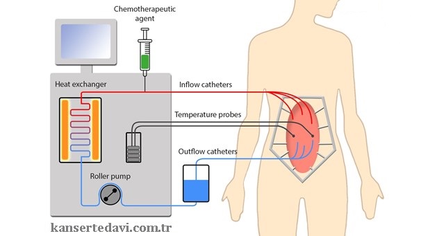 Cerrahi ve HIPEC Uygulaması
