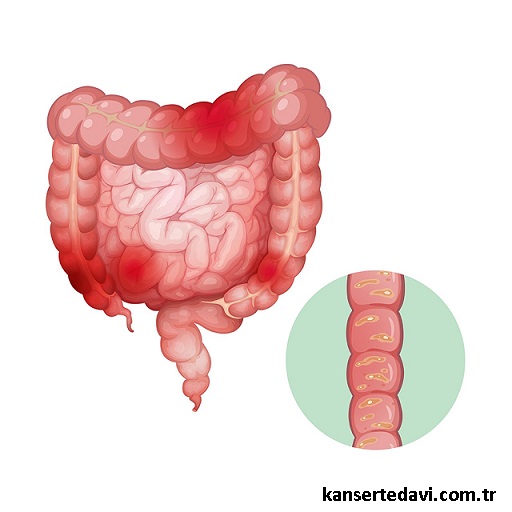 kolon kanseri ve hipec kemoterapi